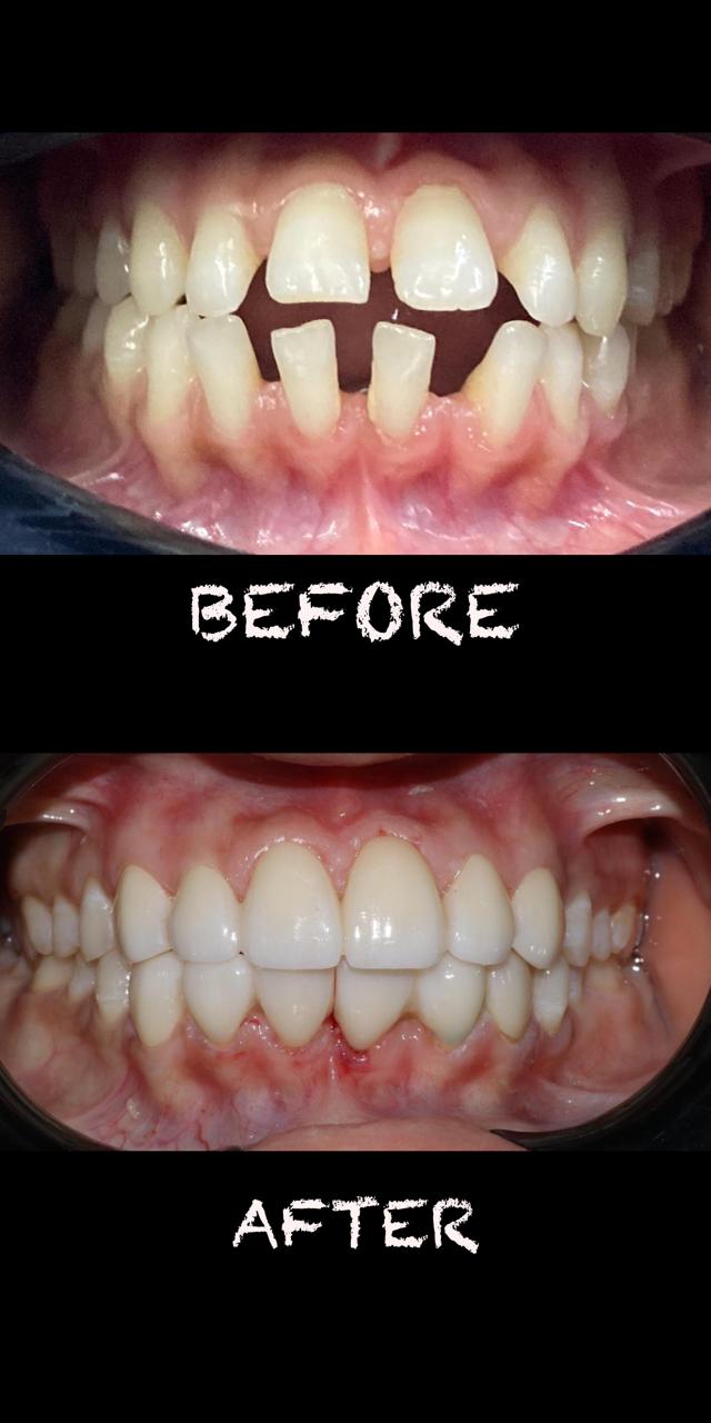 Gap Closure Case