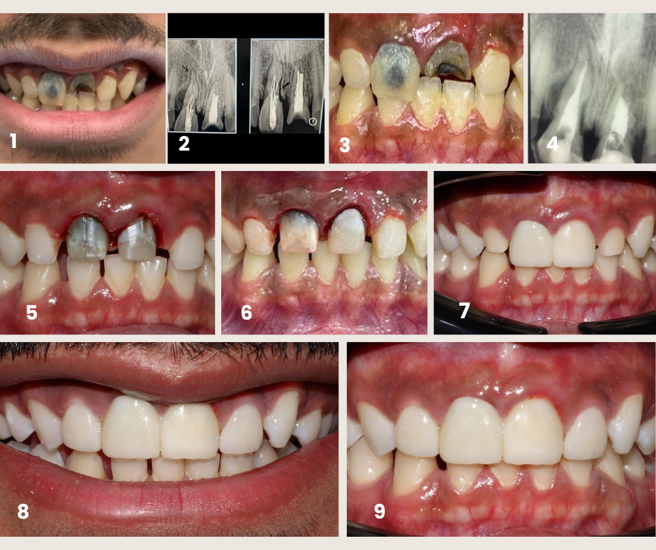 Kids Root Canal Treatment Case