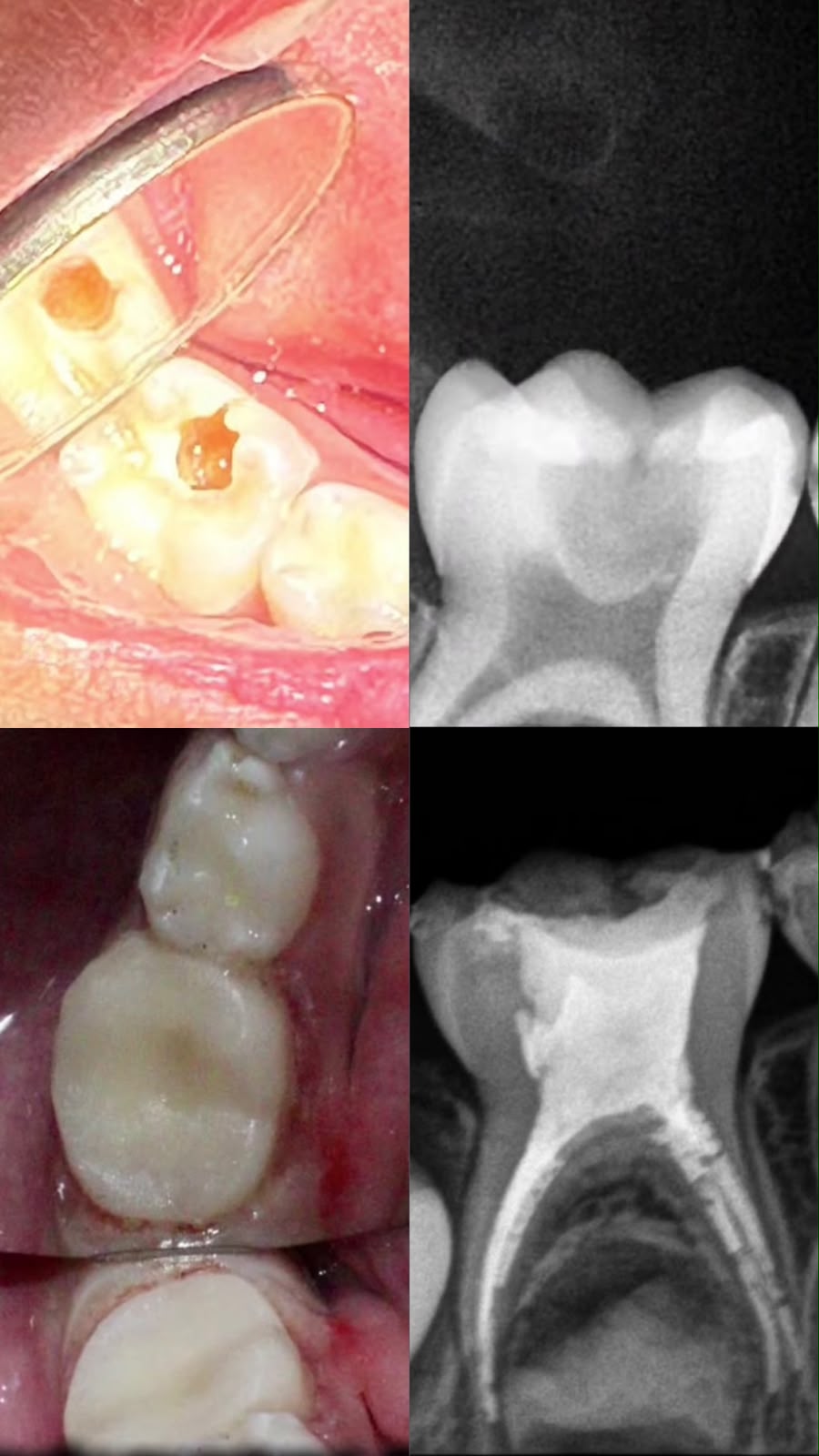 Kids Root Canal Treatment Case