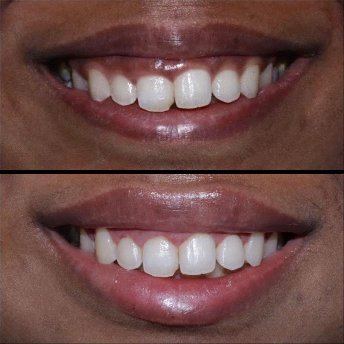 Laser Gummy Smile Correction Case