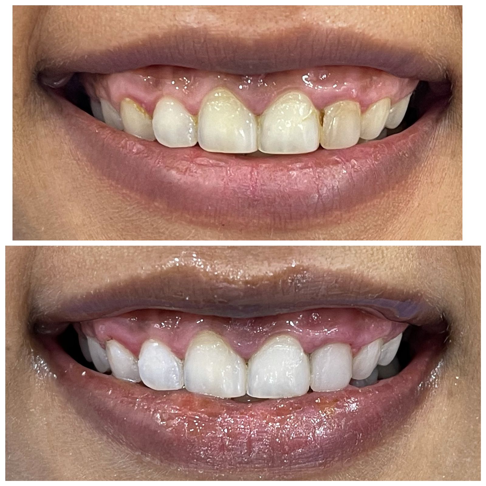 Laser Gummy Smile Correction Case