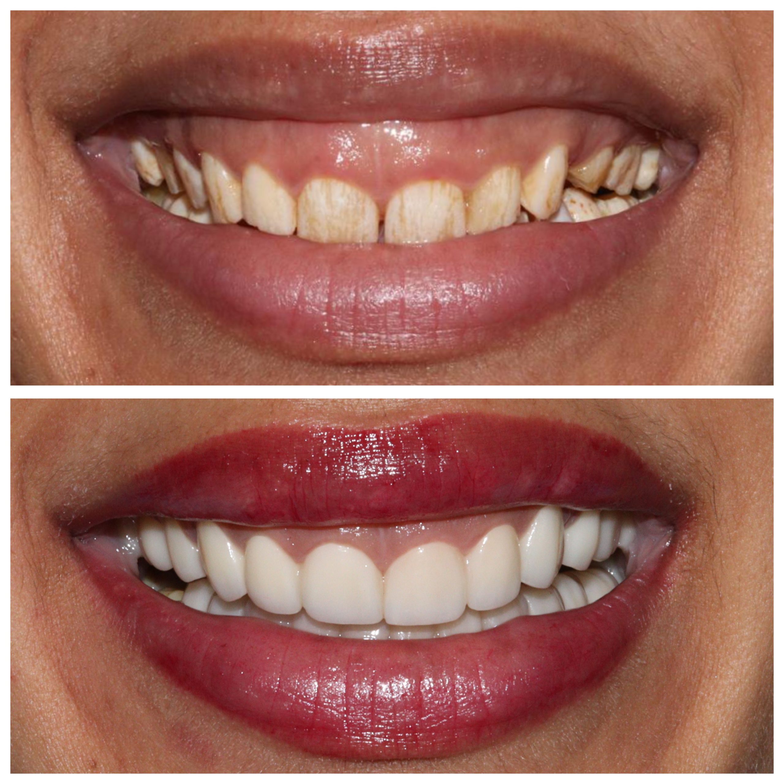 Laser Gummy Smile Correction Case