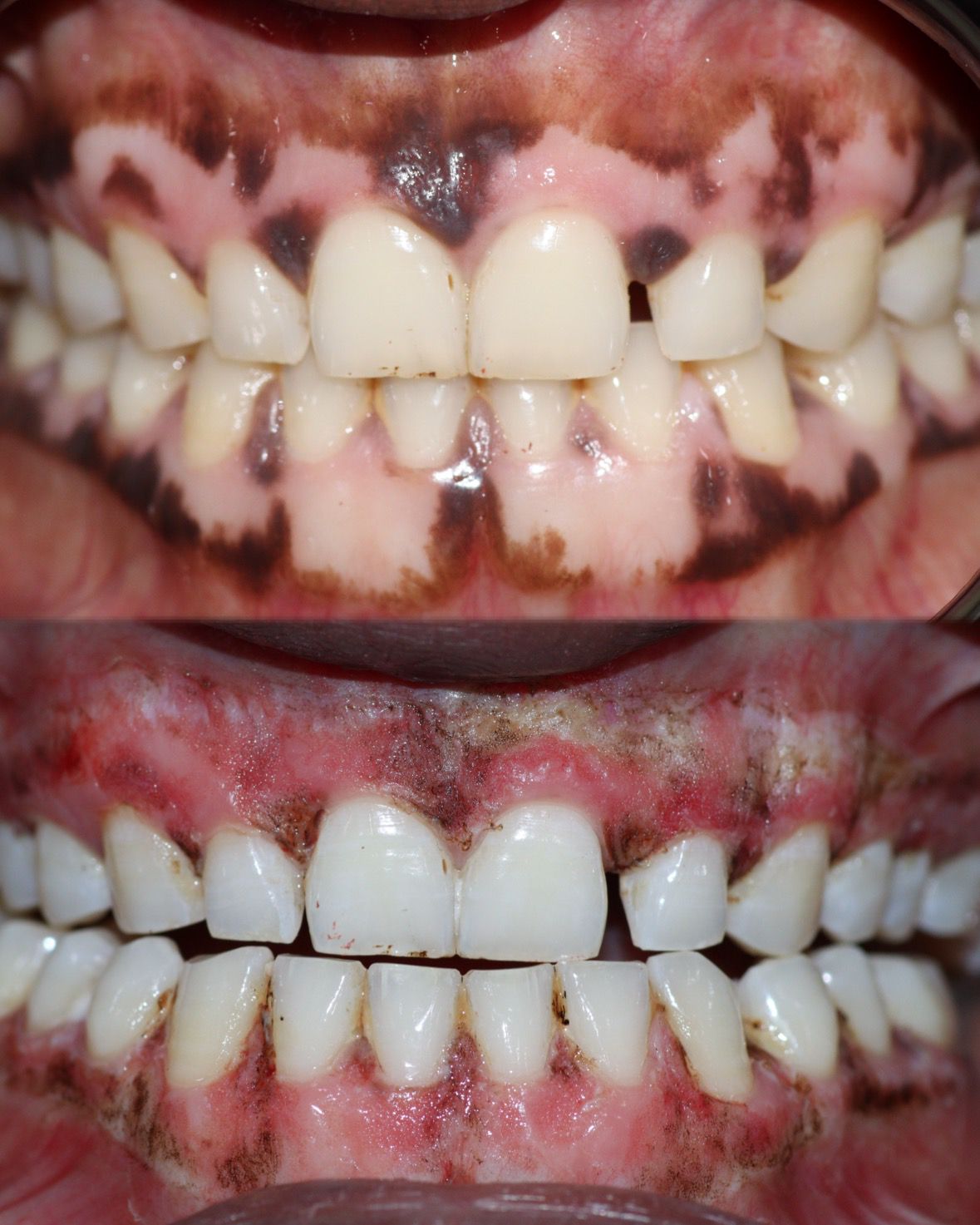 Laser Gums De Pigmentation Case