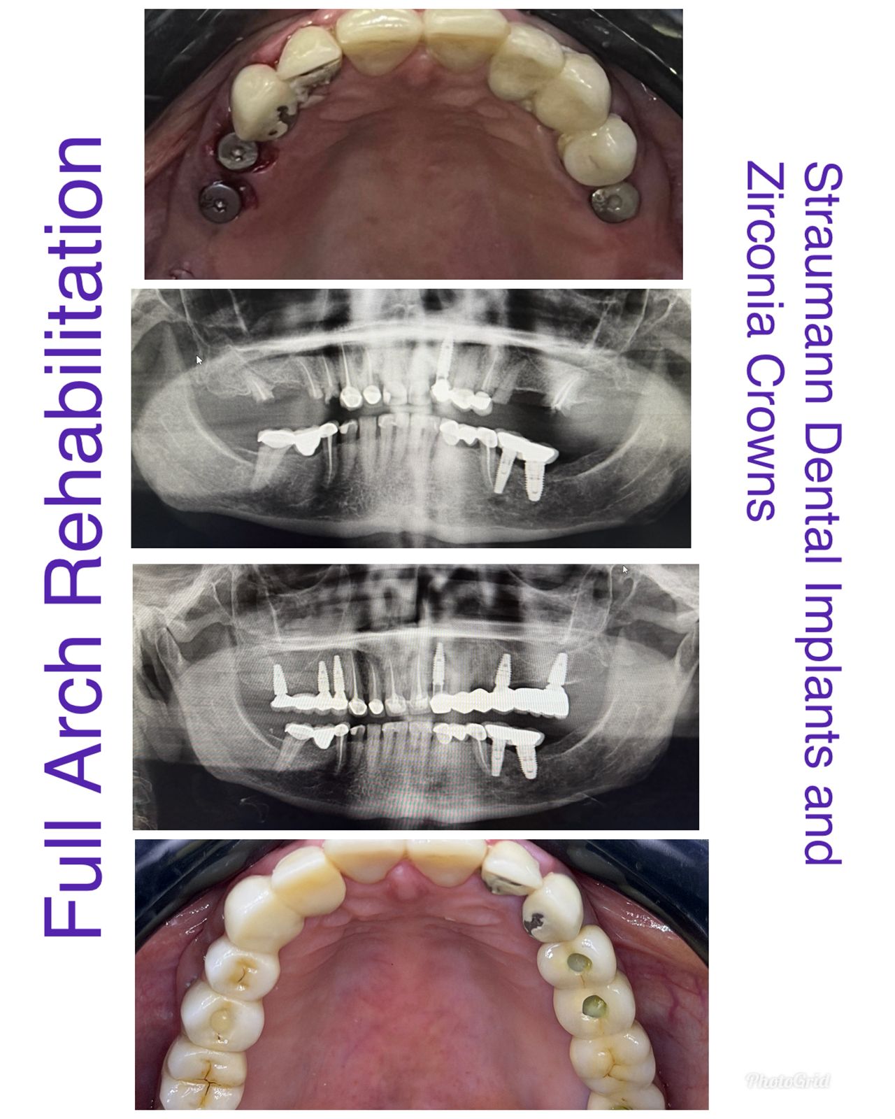 All Teeth Implants Case