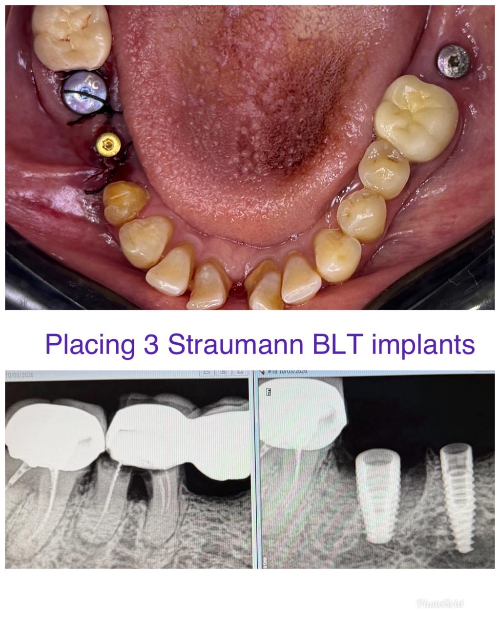 All Teeth Implants Case