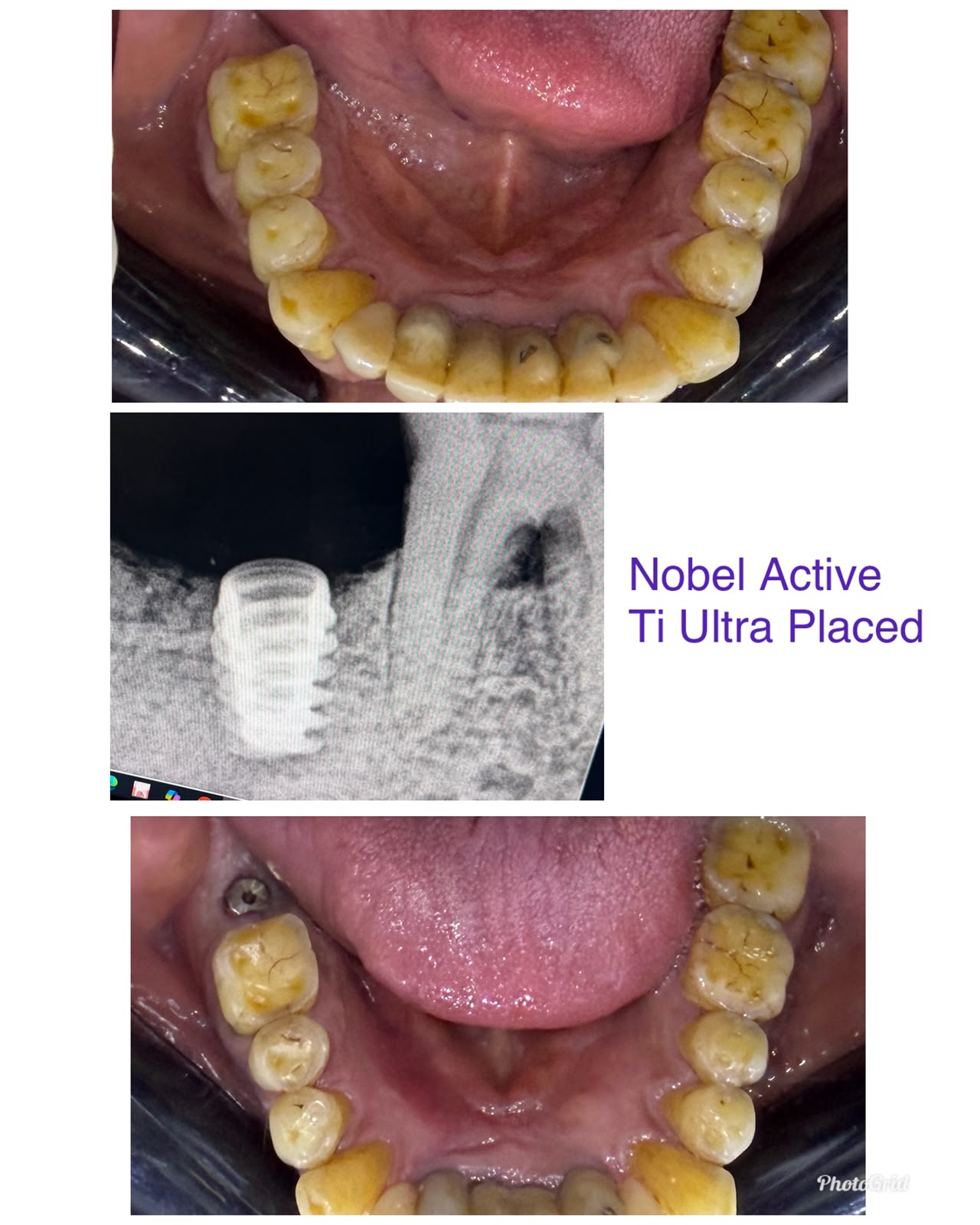 All Teeth Implants Case