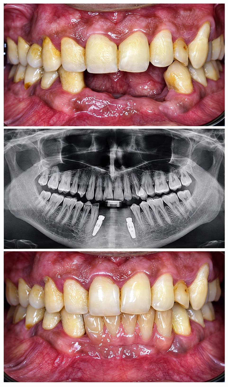 Multiple Teeth Implants Case