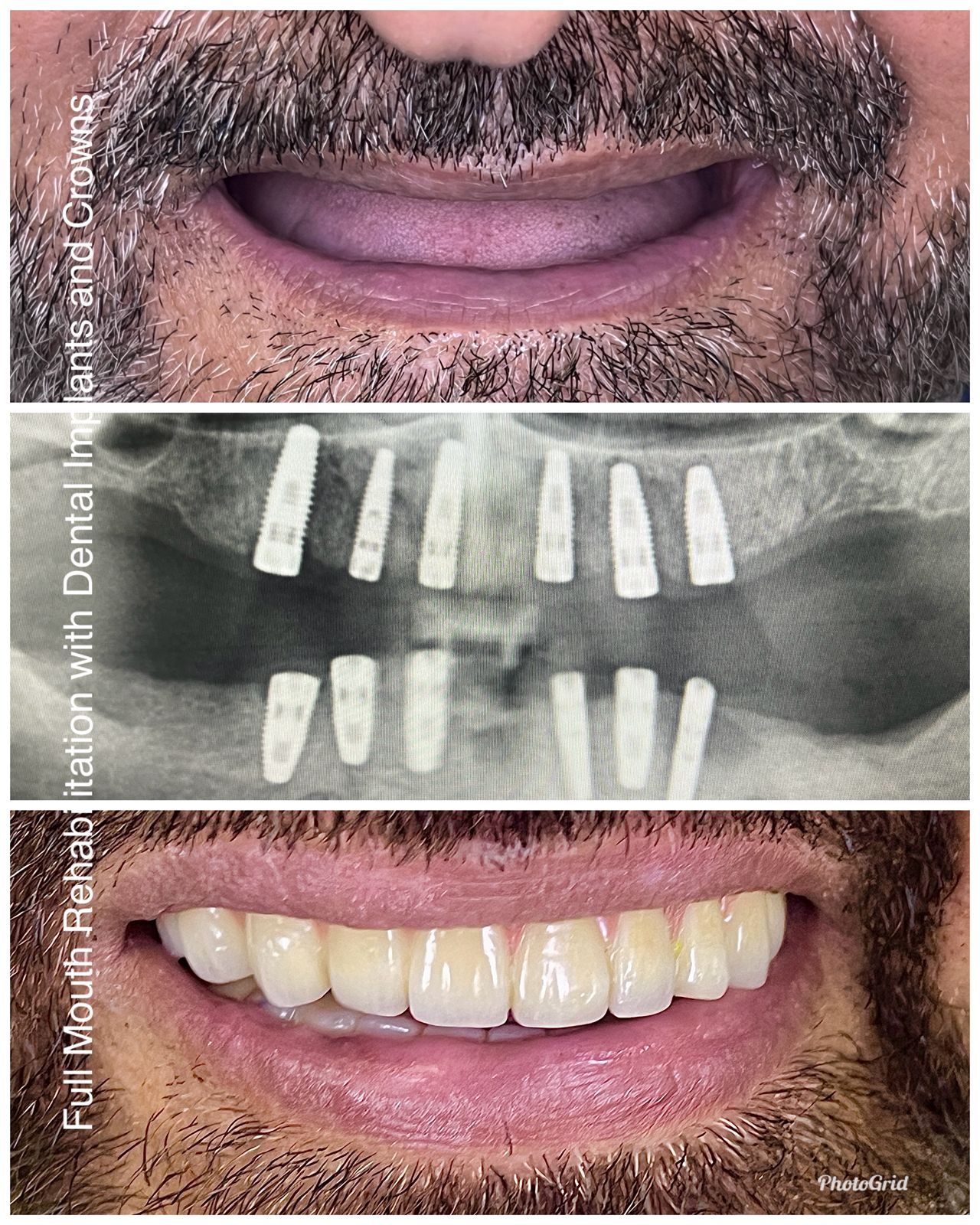 Multiple Teeth Implants Case