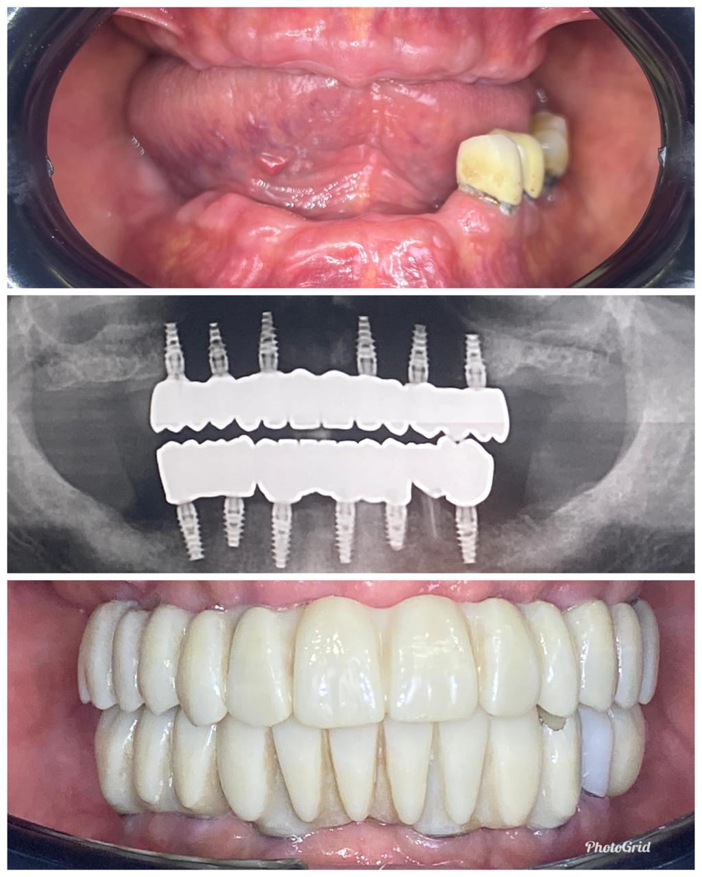 Multiple Teeth Implants Case