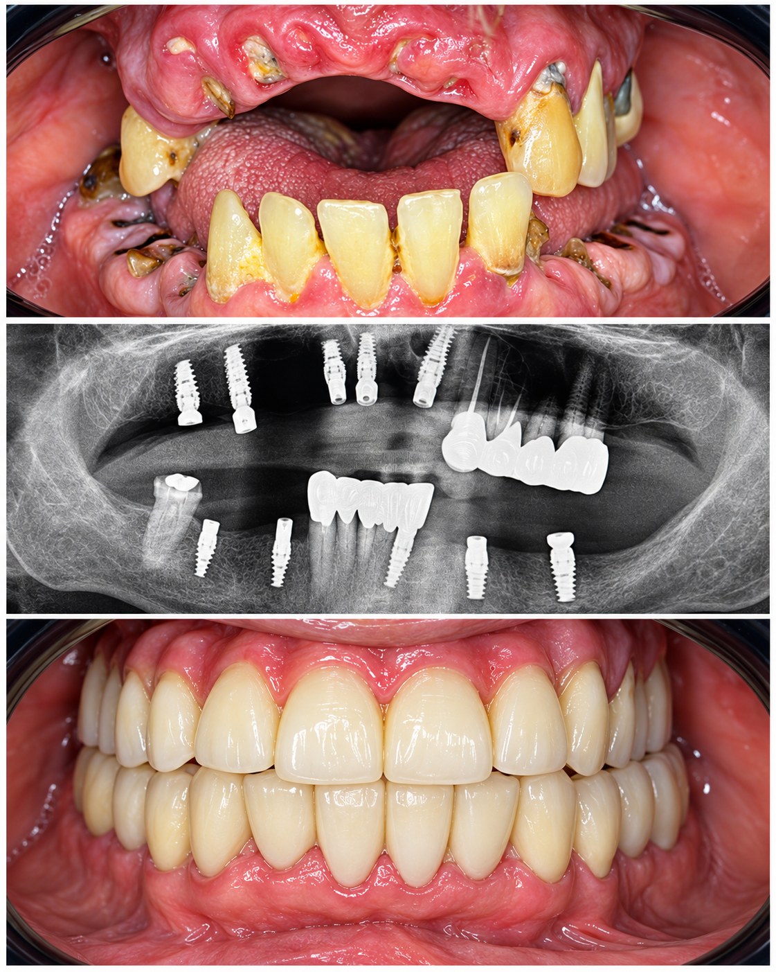 Multiple Teeth Implants Case