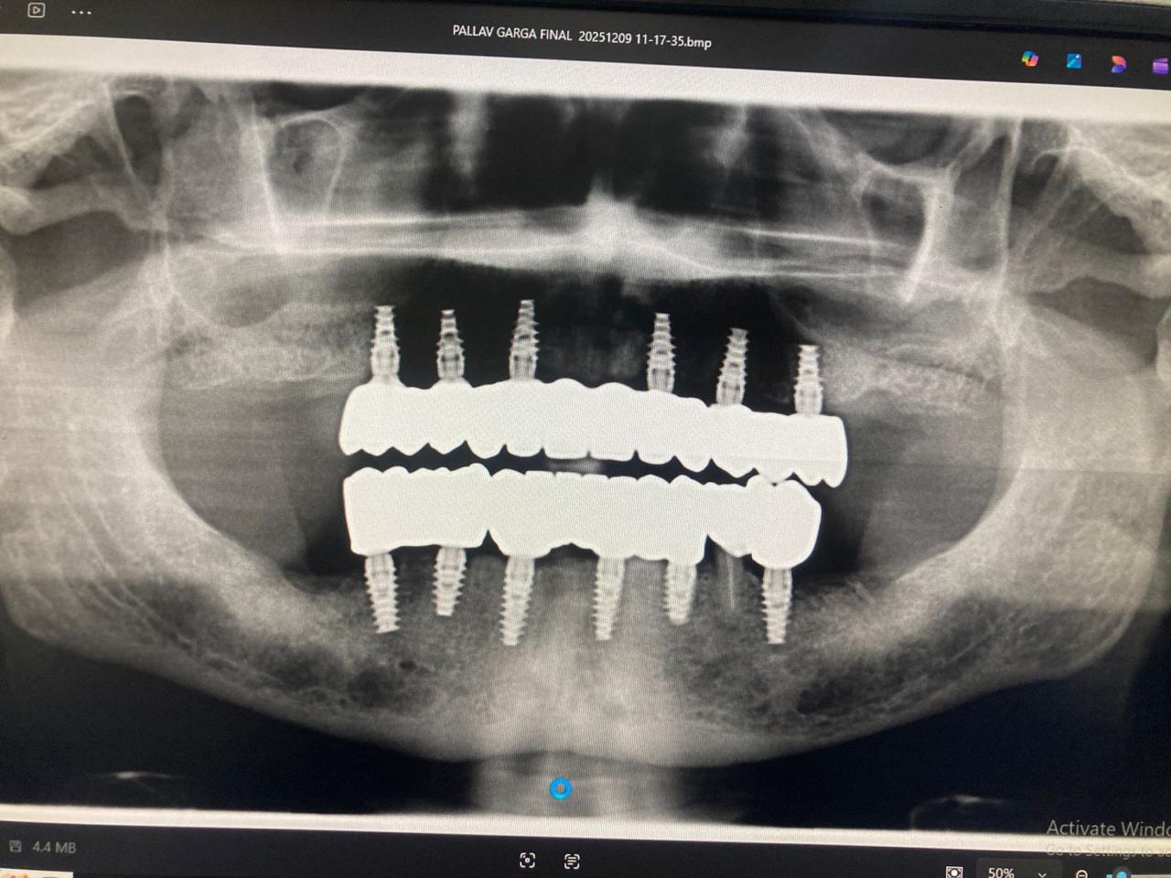 Multiple Teeth Implants Case