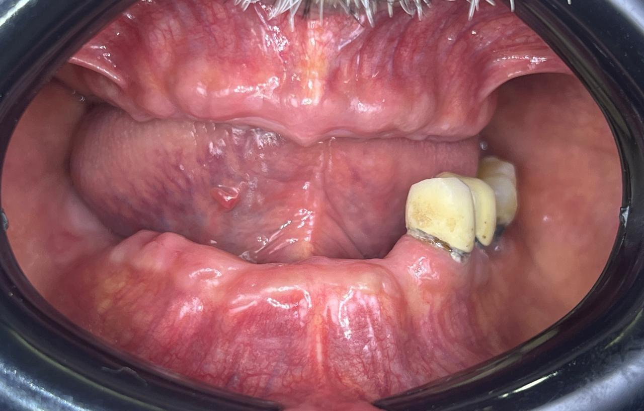 Multiple Teeth Implants Case