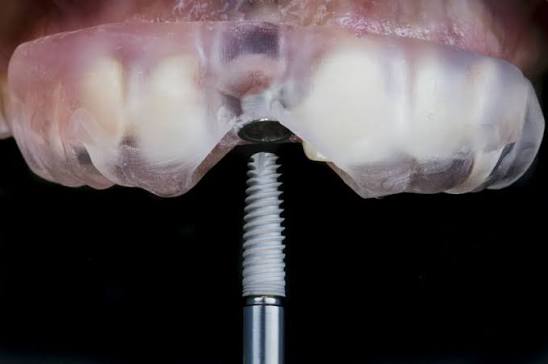 Nobel Guide Computer Guided Surgery Case