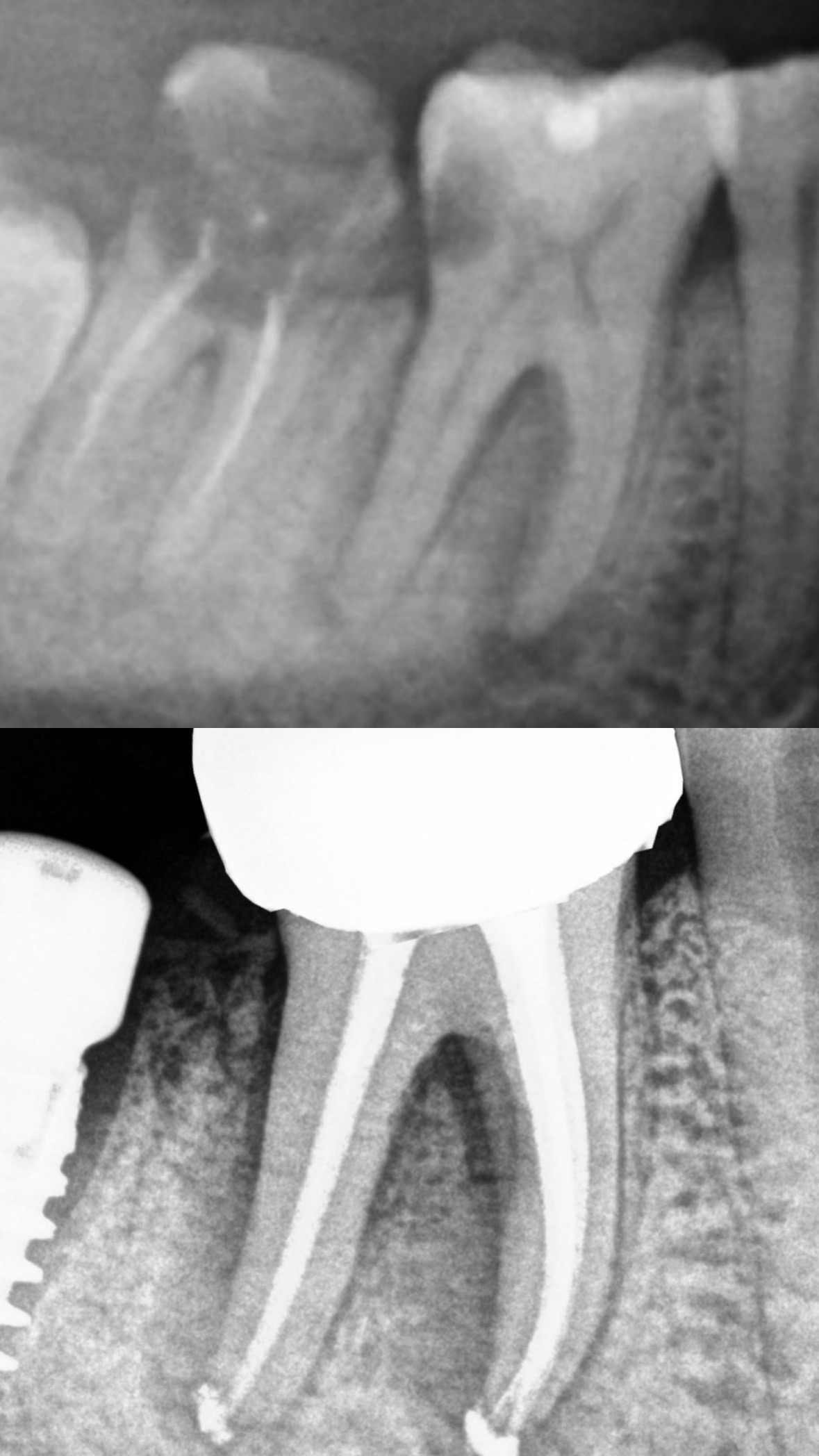 Root Canal Treatment Case