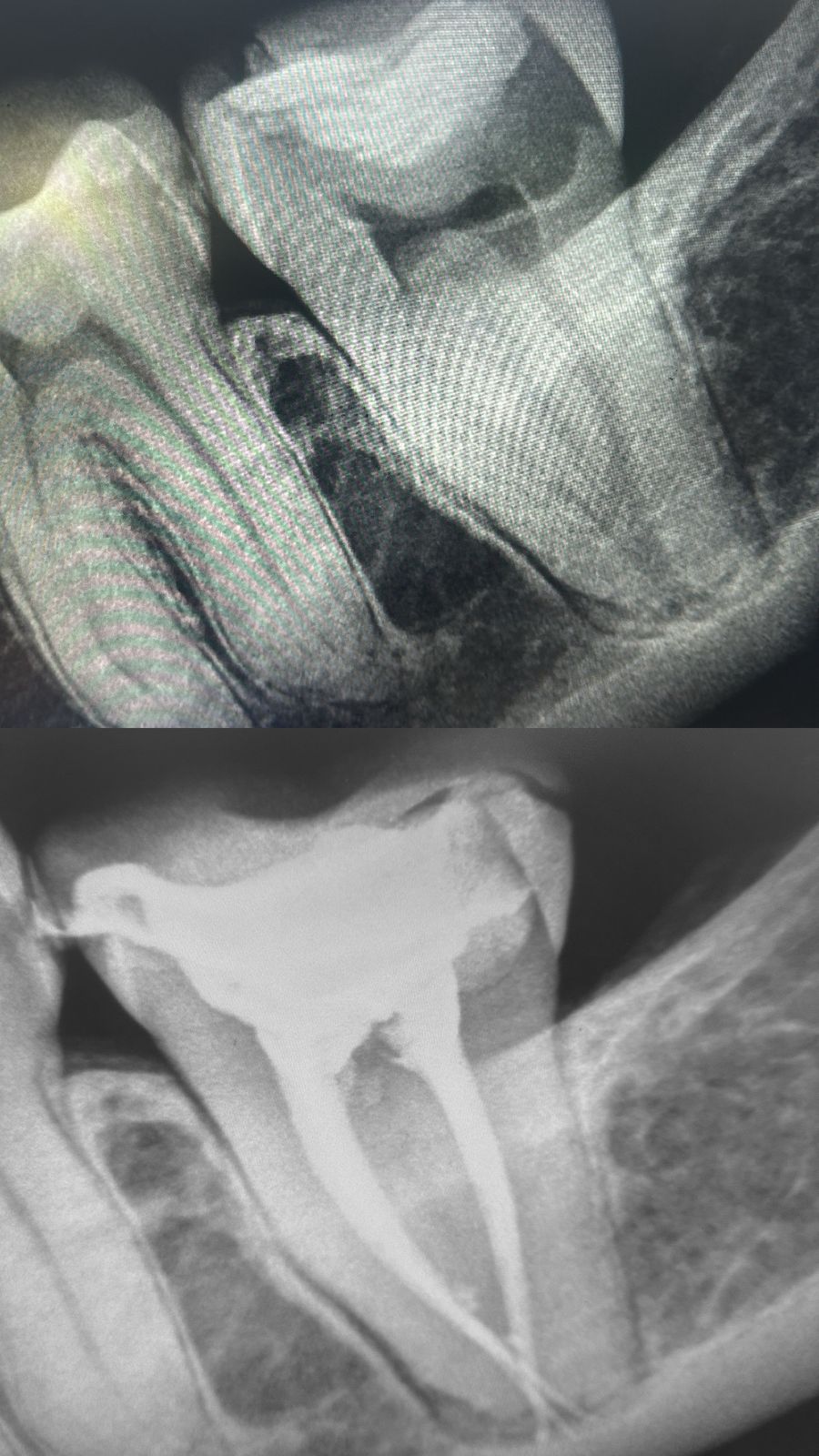 Root Canal Treatment Case