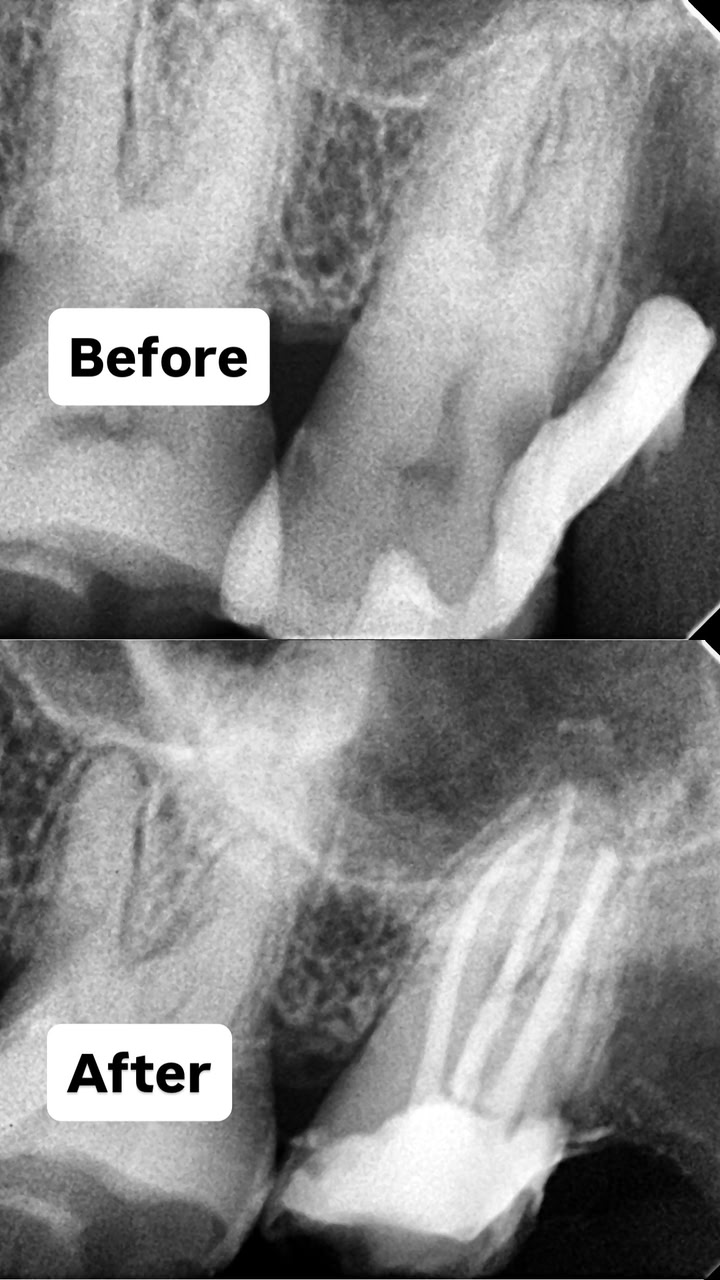 Root Canal Treatment Case