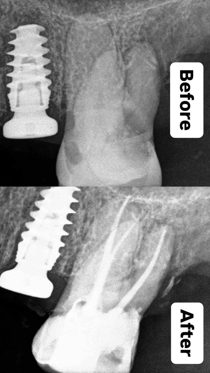Root Canal Treatment Case