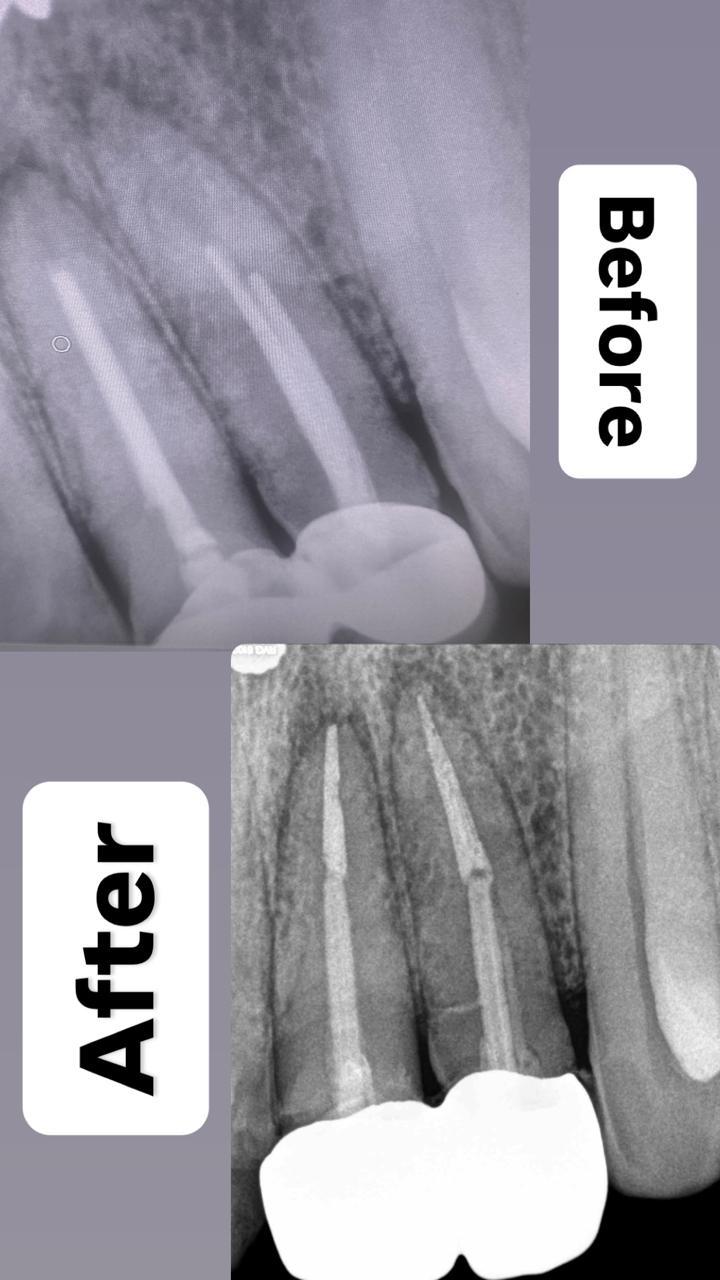 Root Canal Treatment Case