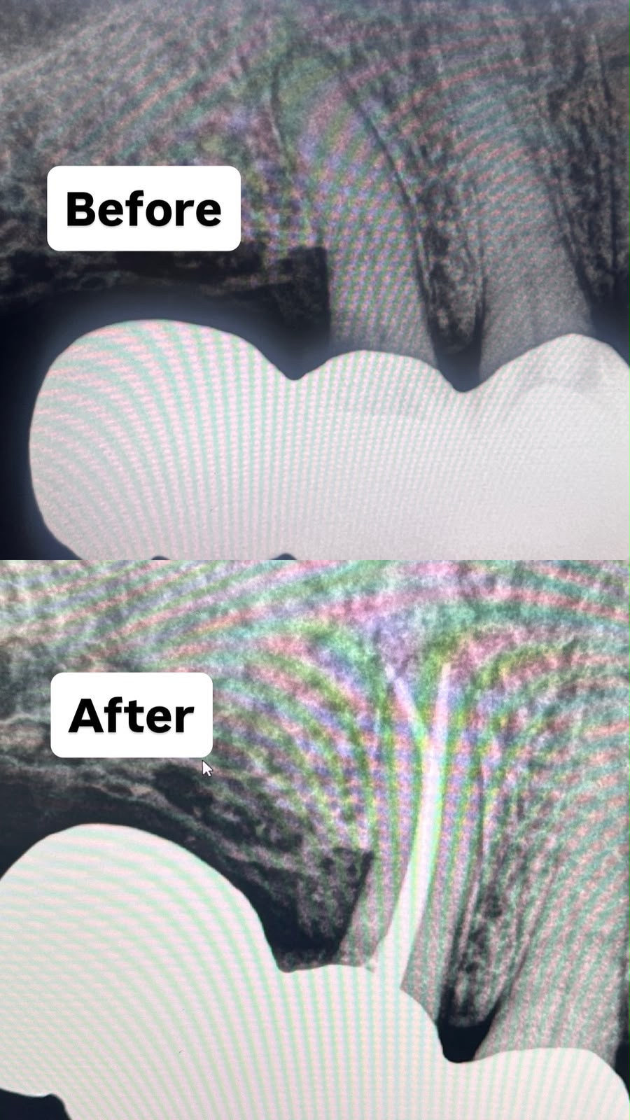 Root Canal Treatment Case