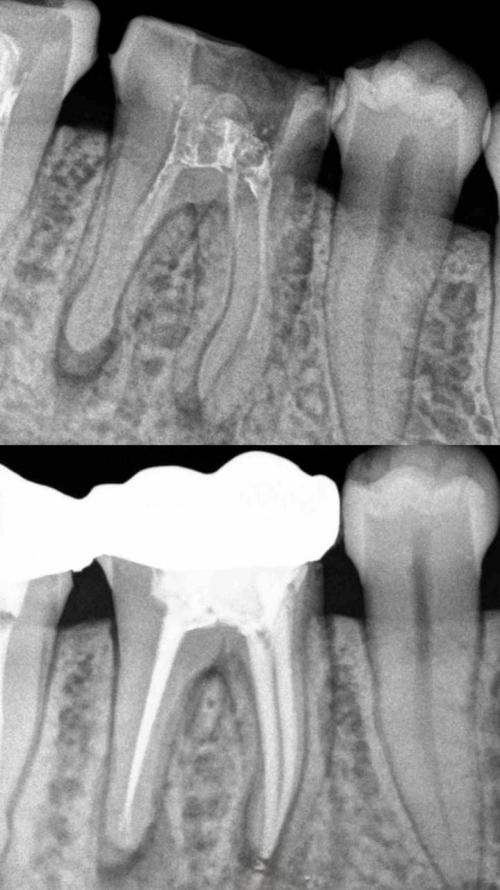 Root Canal Treatment Case