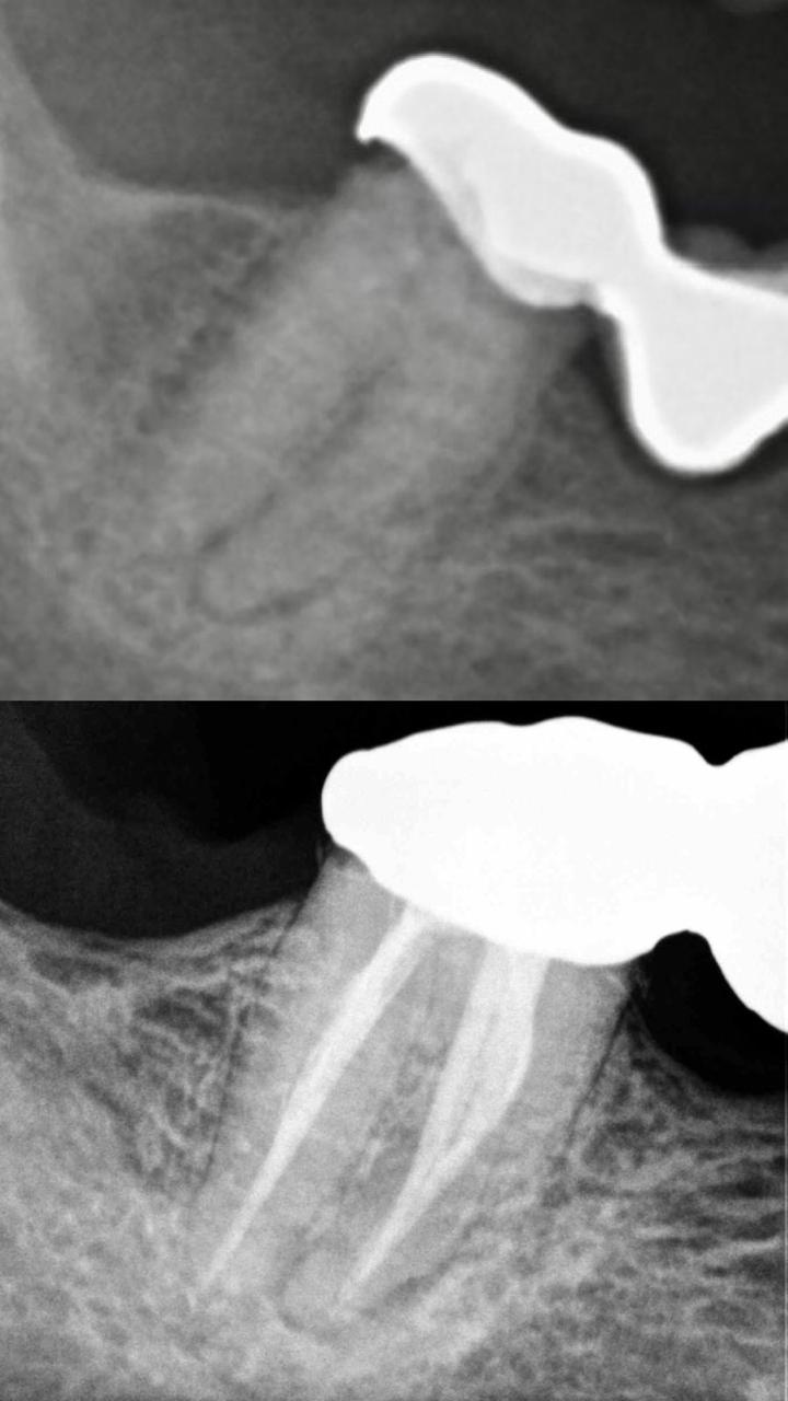 Root Canal Treatment Case