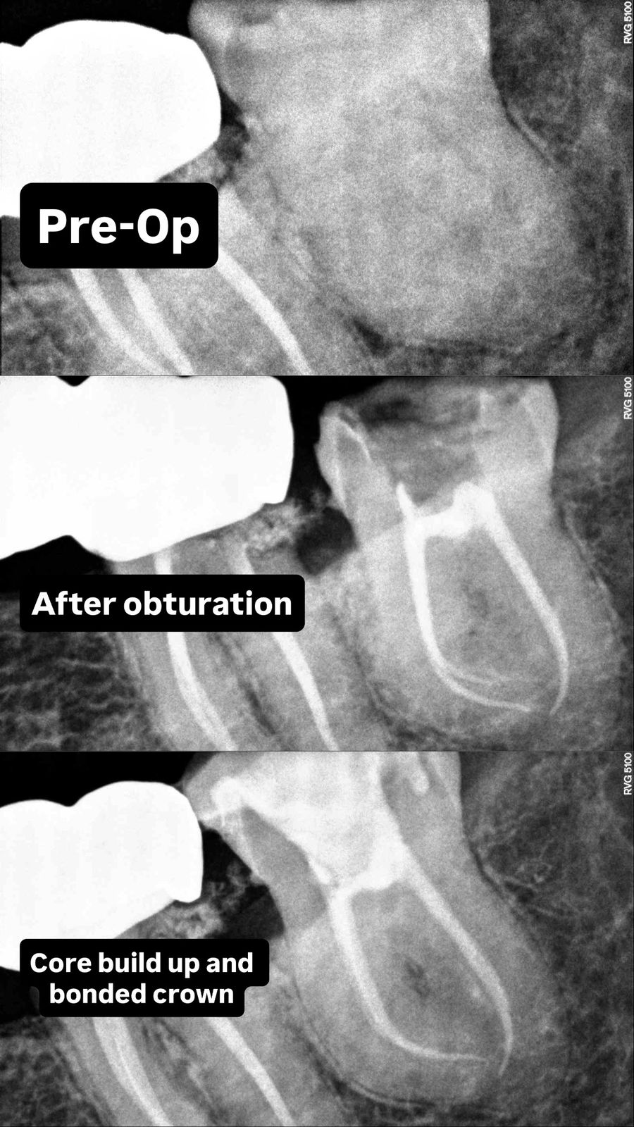 Root Canal Treatment Case