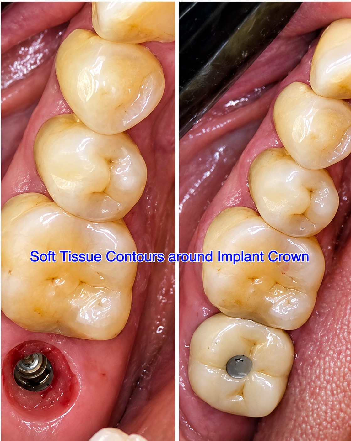 Single Tooth Implant Case