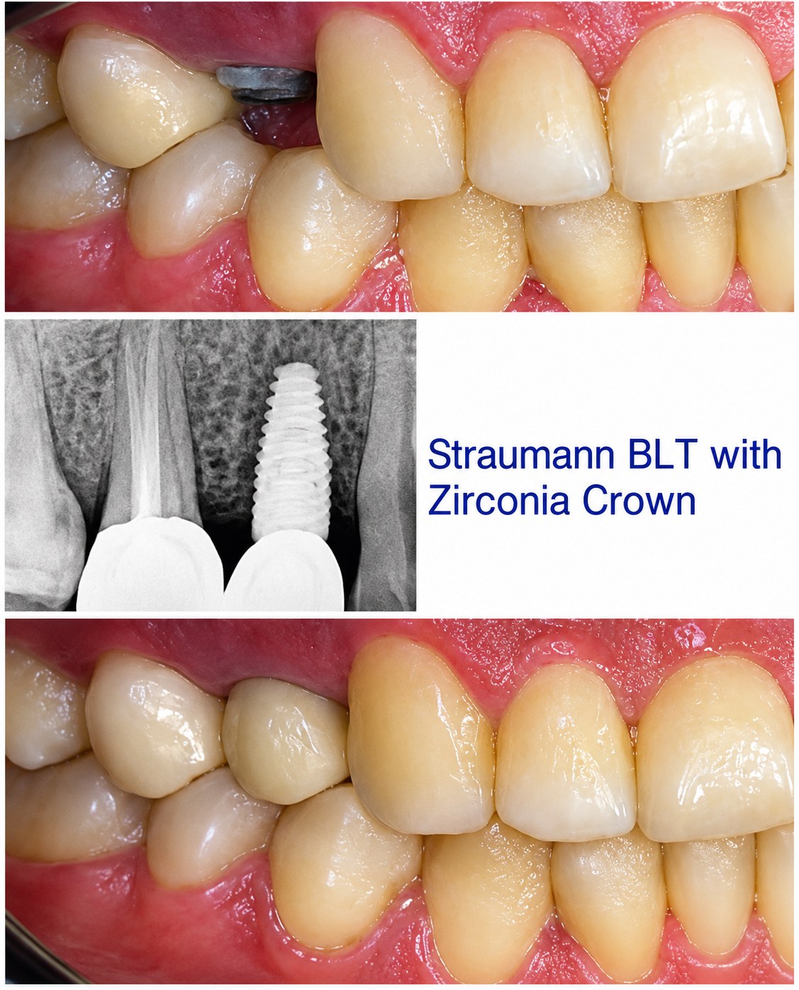 Single Tooth Implant Case