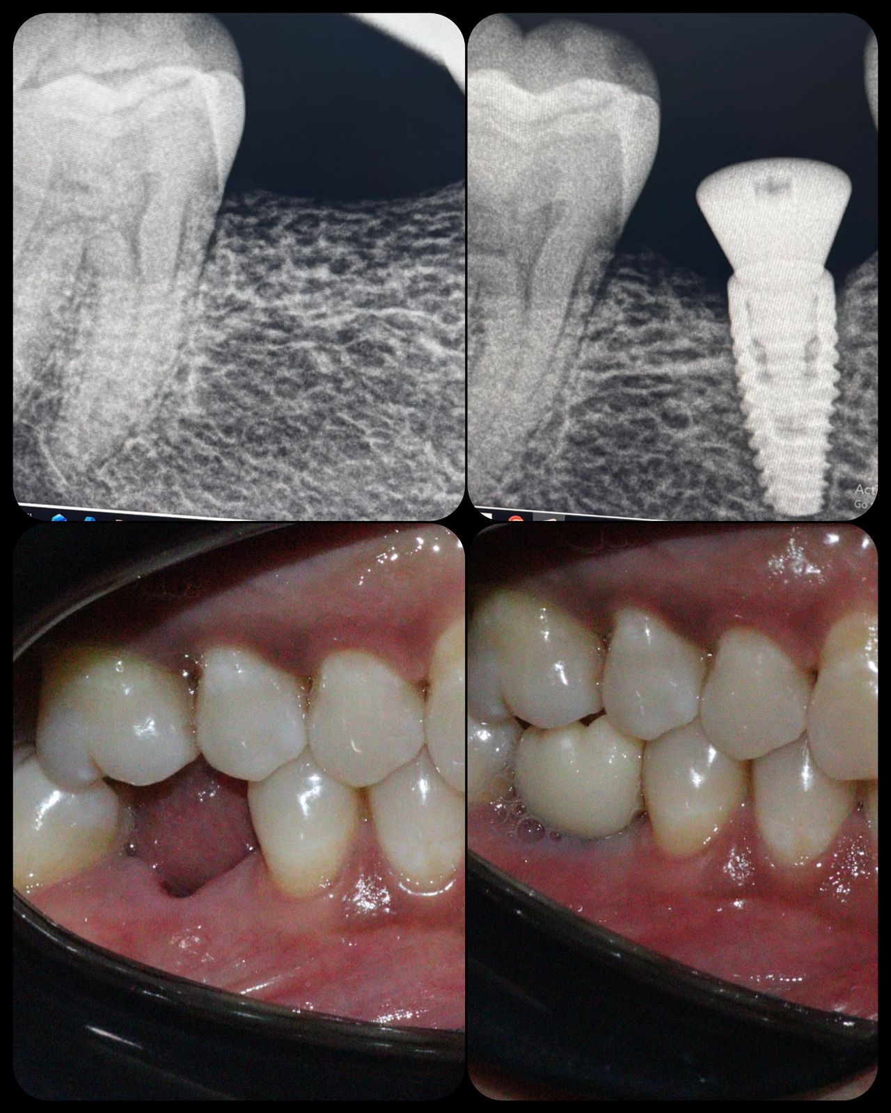 Single Tooth Implant Case