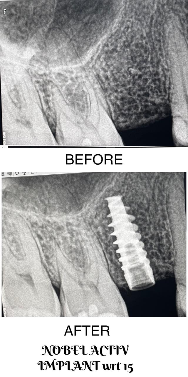 Single Tooth Implant Case