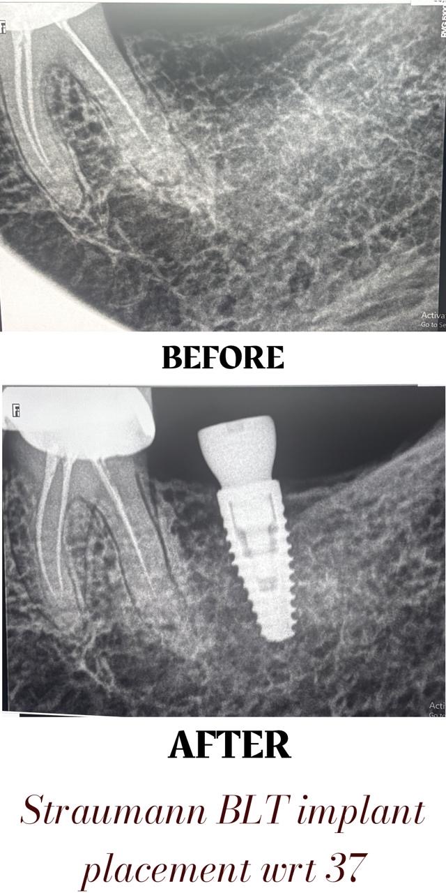 Single Tooth Implant Case