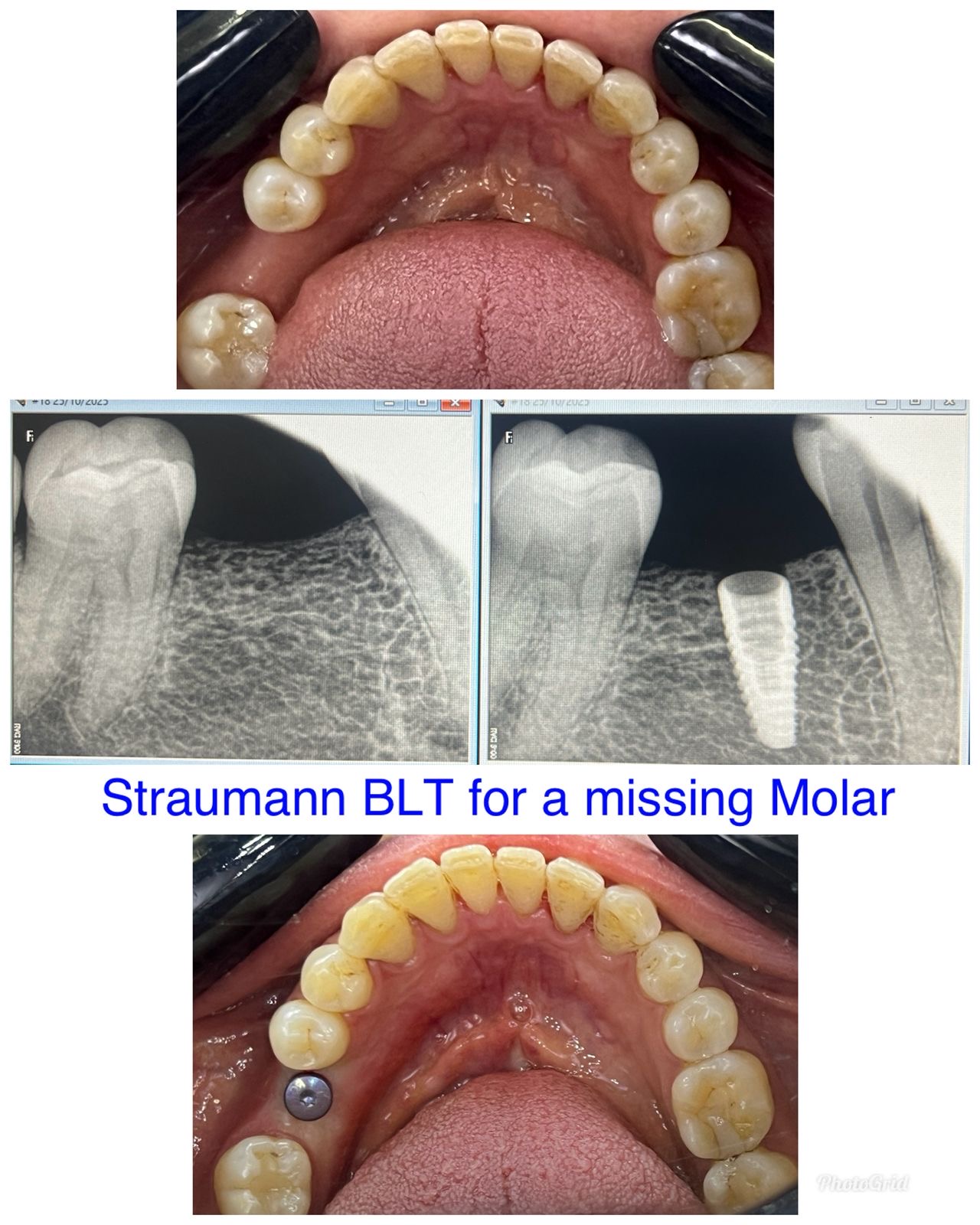 Single Tooth Implant Case