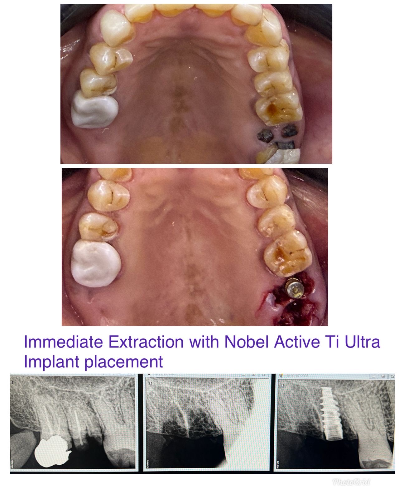 Single Tooth Implant Case